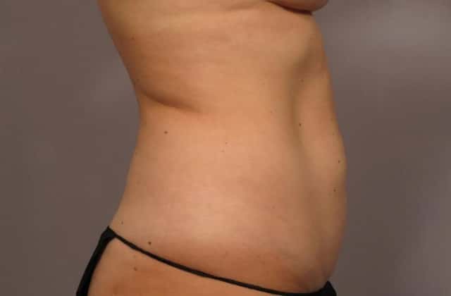 Tummy Tuck, Right Side View, Before and After 1 year Photos by Dr. Kent Hasen