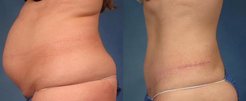Before & After tummy tuck & liposuction