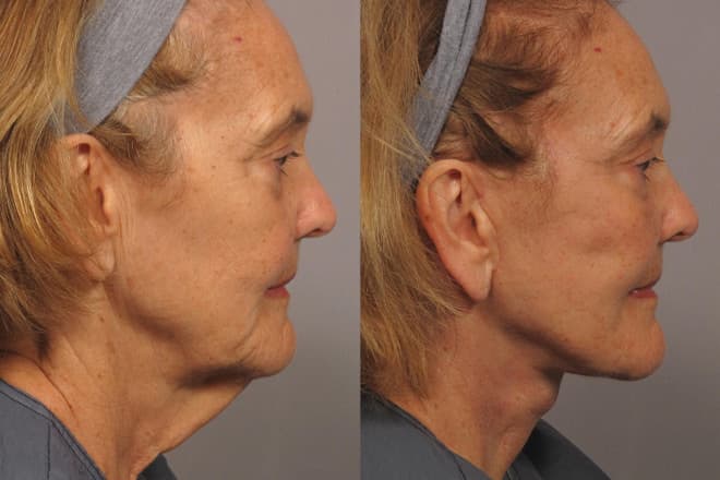Before & After facelift