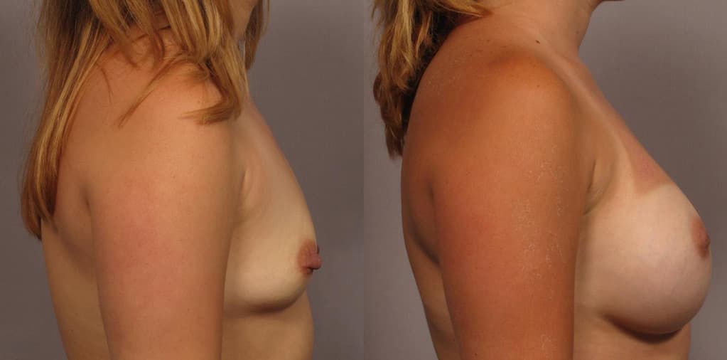 Before & After breast augmentation and nipple reduction