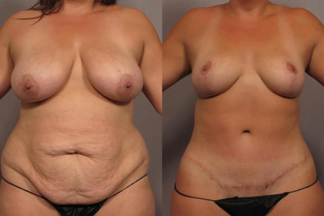 Before & After mommy makeover