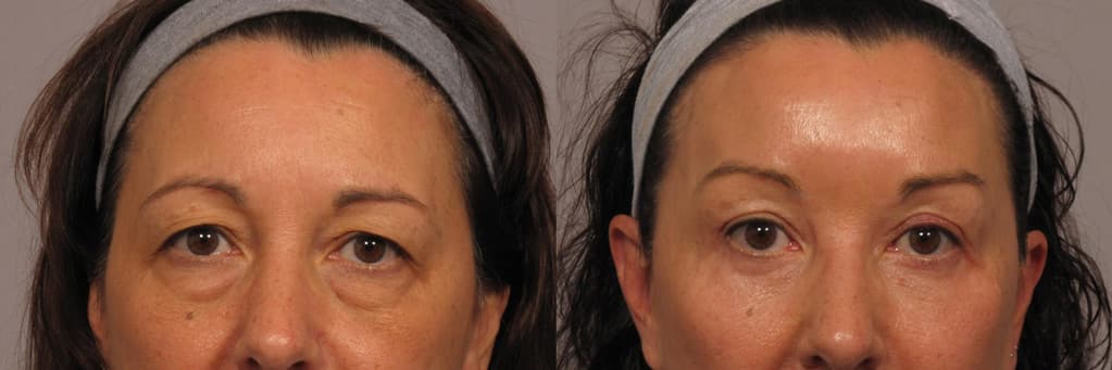 Before & After brow lift and eyelid lift