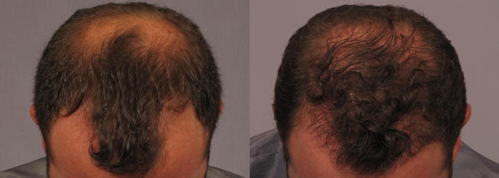 Before & After NeoGraft hair transplant