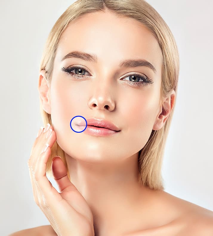 Treatment planner model showing thin lips