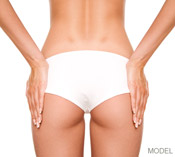 Top 3 Areas for Liposuction woman's buttocks in white underwear