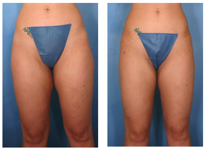 Liposuction before and after photos front view of woman's thighs