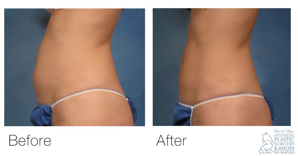 CoolSculpting before and after woman's abdomen side view