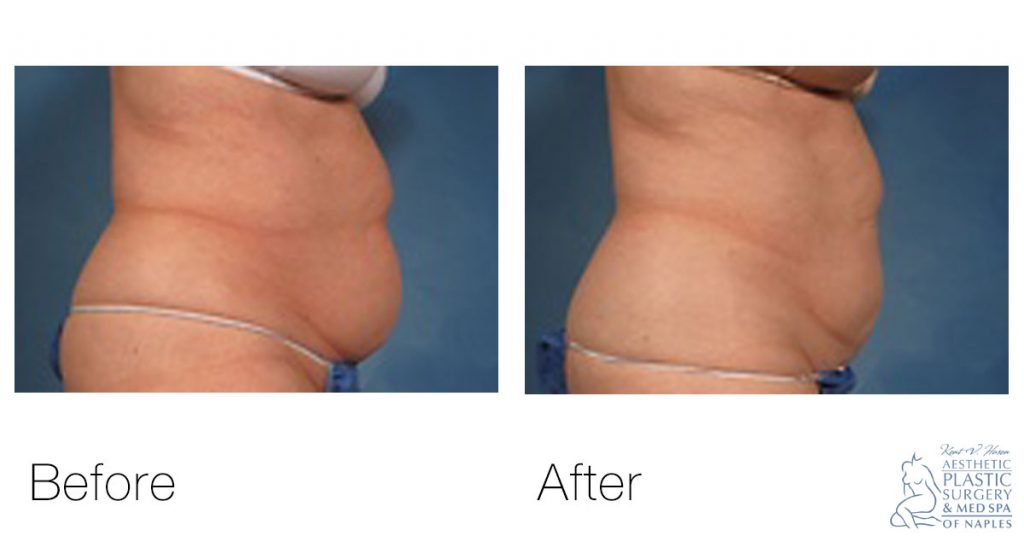 woman's stomach before and after coolsculpting
