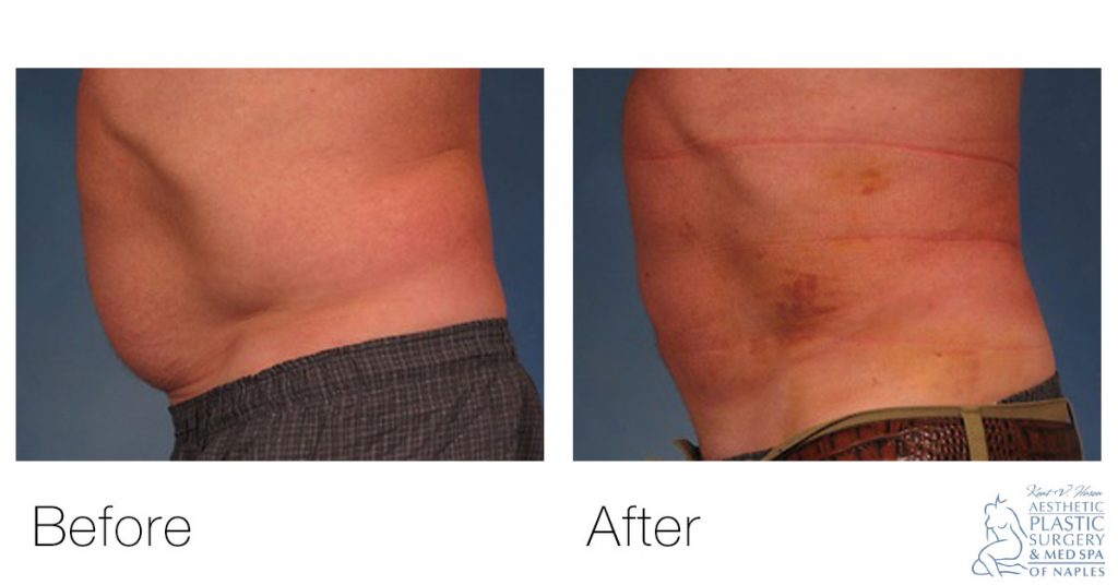 male's stomach before and after smartlipo liposuction