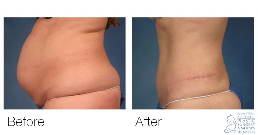 woman's stomach before and after lipo and tummy tuck procedure