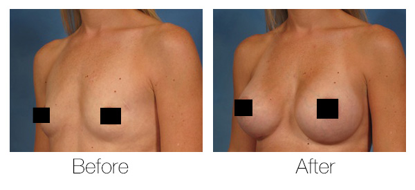 woman's breasts before and after implants