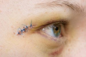 stitches near eyelid