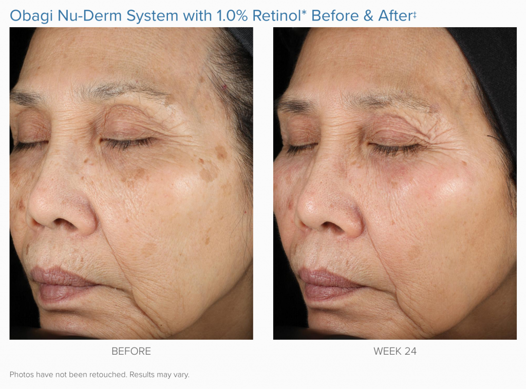 woman's face before and after 24 weeks of Obagi Nu-Derm System treatment