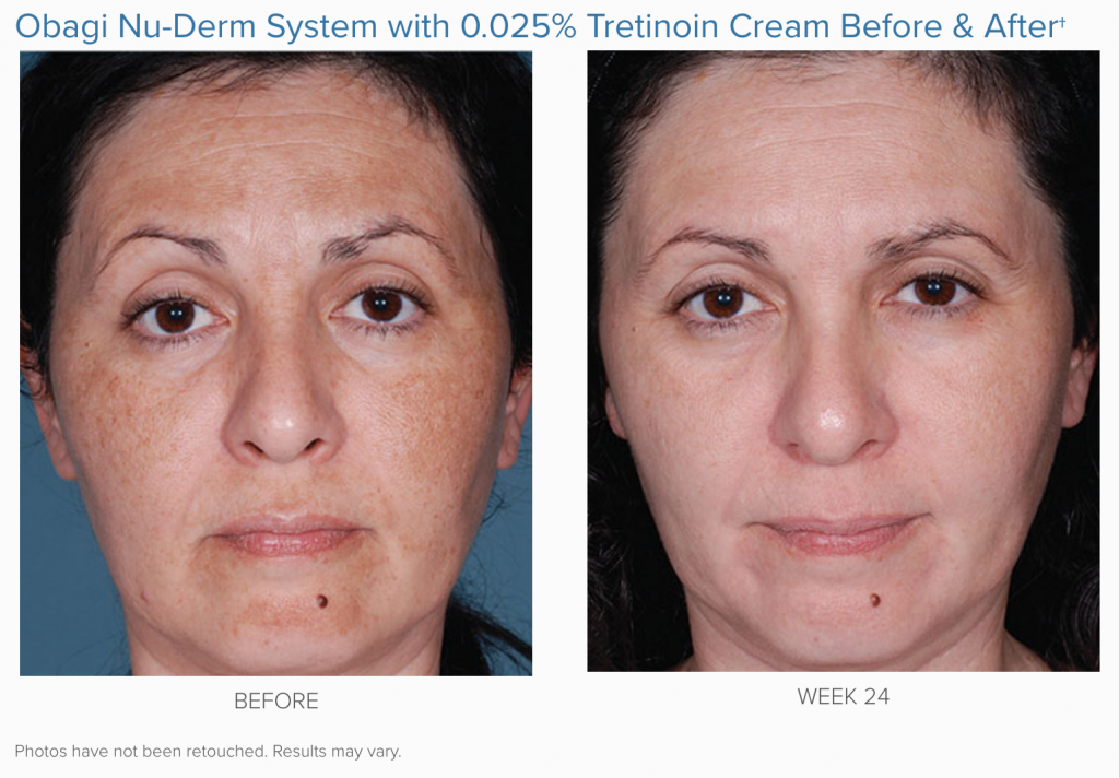woman before and after 24 weeks of Obagi Nu-Derm system