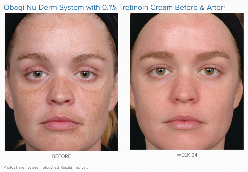 woman before and after 24 weeks of Obagi Nu-Derm system