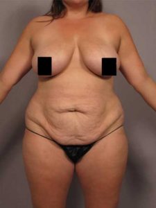 Front view example of how breast enhancement and body contouring images should be taken