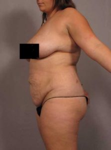 Side view example of how breast enhancement and body contouring images should be taken
