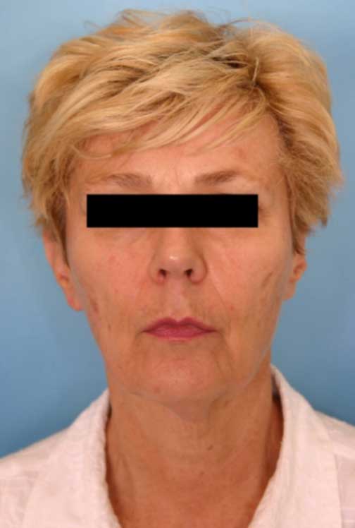 Front view example of how facial procedure images should be taken
