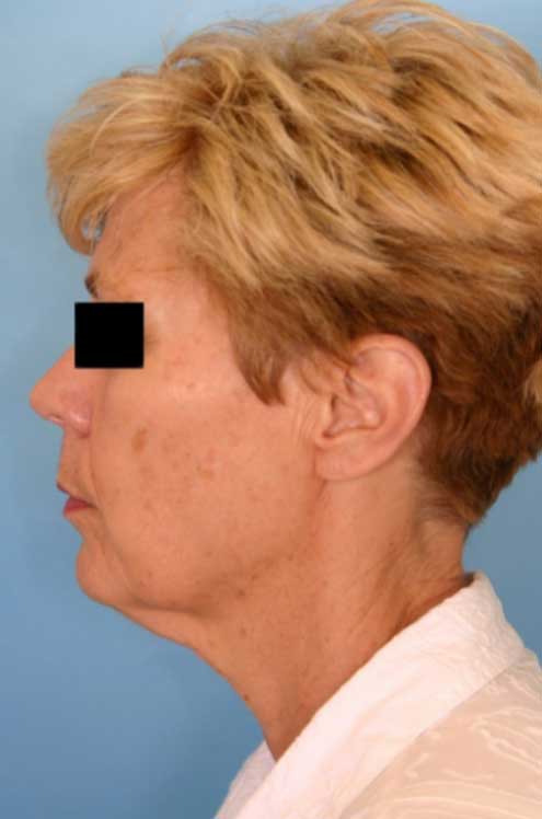 Side view example of how facial procedure images should be taken