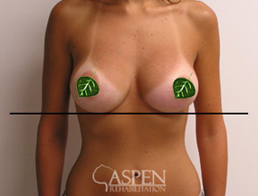 After Capsular Contracture Treatment