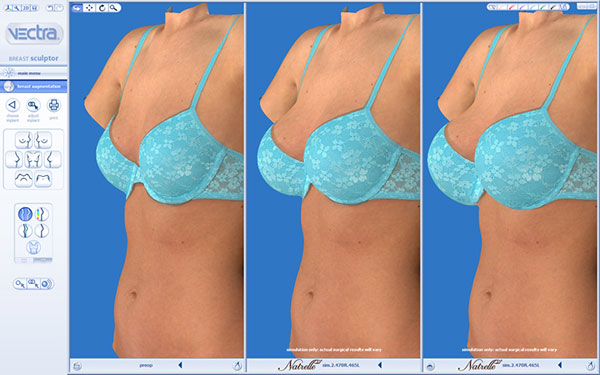 Breast 3D simulation