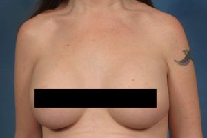 Patient Case: Revising a Breast Augmentation 