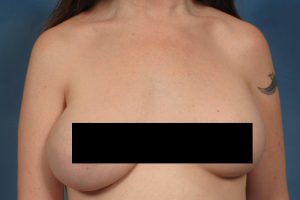 Patient Case: Revising a Breast Augmentation