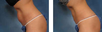 CoolSculpting-Before-and-After2