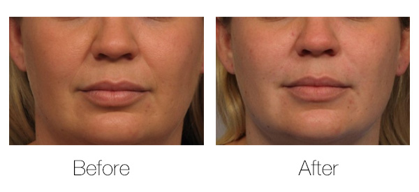 Before and After Image of Filler