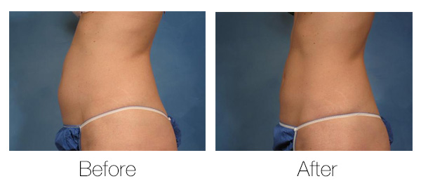 CoolSculpting® Before-and-After