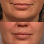 LK2 juvederm