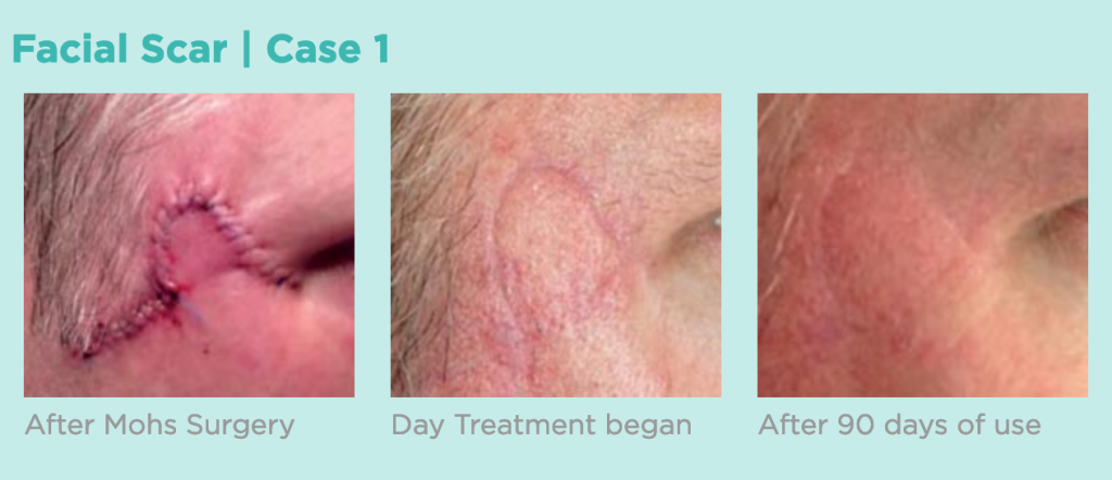Before and after siligen scar treatment