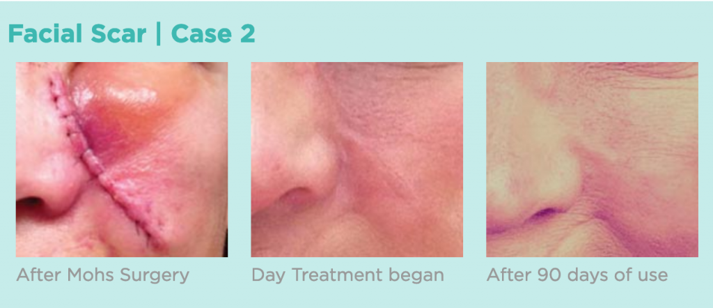 Before and after siligen scar refinement treatment