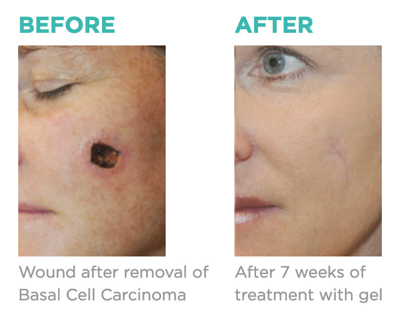 Before and after siligen scar refinement treatment for skin cancer patient