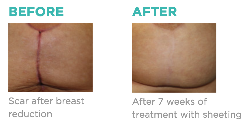 before and after siligen scar refinement treatment for breast reduction patient