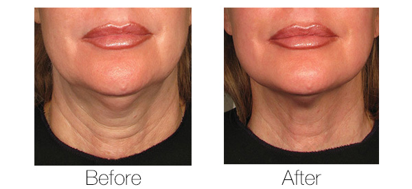 Ultherapy Before and After Images