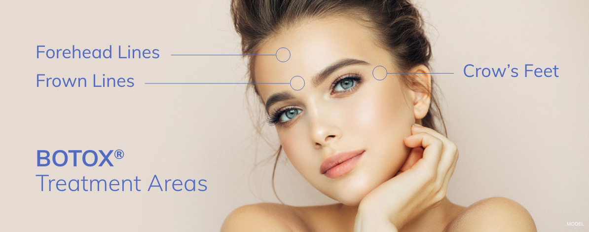 Botox Treatment areas include forehead lines, frown lines, and crow's feet.