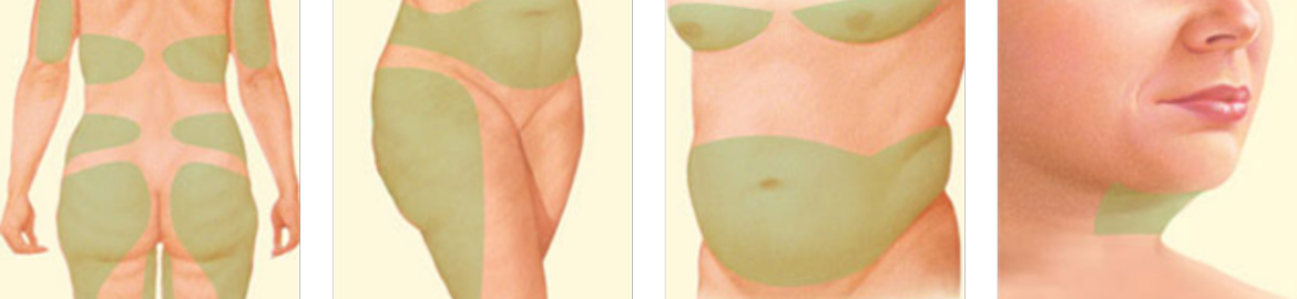 Liposuction areas highlighted on the buttocks, back, thighs, stomach, and neck