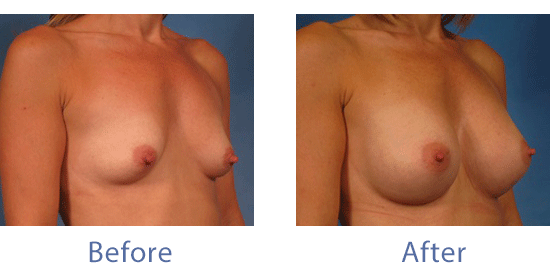 See before-and-after images from Dr. Hasen's real Fort Myers breast augmentation patients.