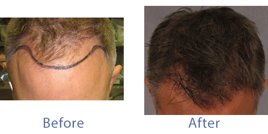 mono hair replacement systems