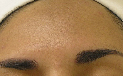 After Hydrafacial treatment