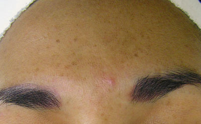 Before Hydrafacial treatment