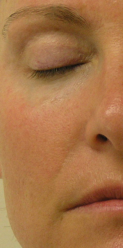 After Hydrafacial on nasal fold