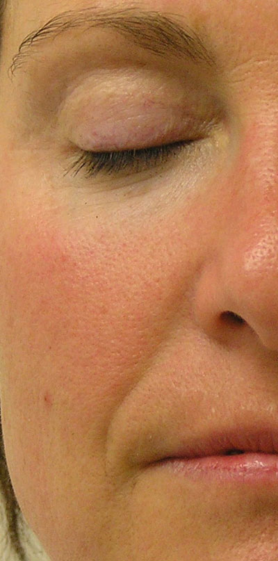 Before Hydrafacial on nasal fold