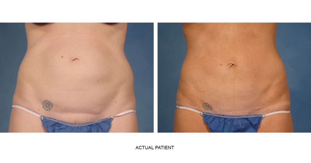 Full Tummy Tuck After C-Section 39-Year-Old Patient Left Profile Photos -  Tummy Tuck Before and After - DeLuca Plastic Surgery