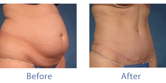 See before-and-after images of tummy tuck patients in Fort Myers, FL.