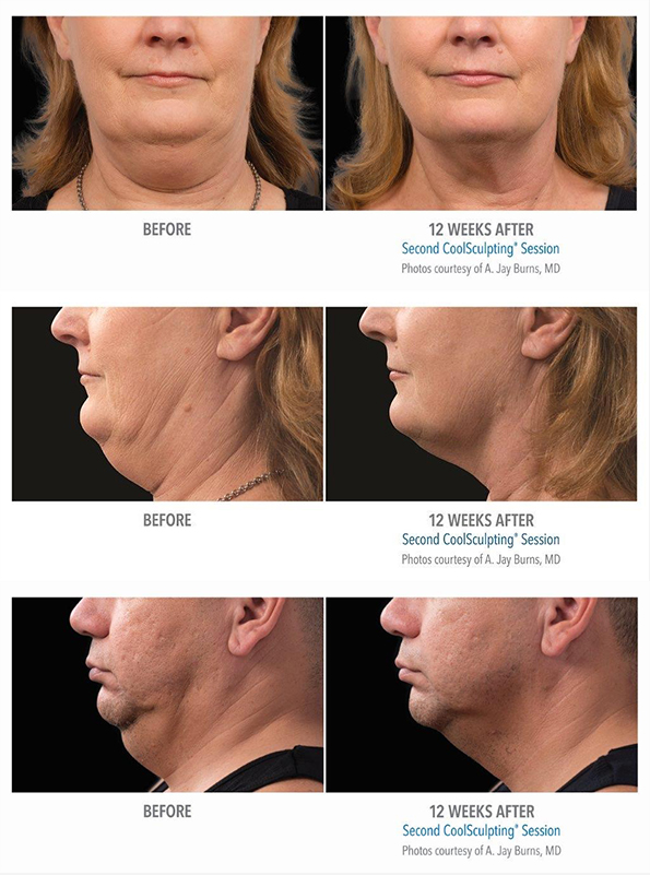 CoolSculpting before-and after photos of reduced double chins