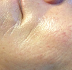 After microneedling on face