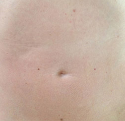 After microneedling on stomach