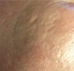 After microneedling